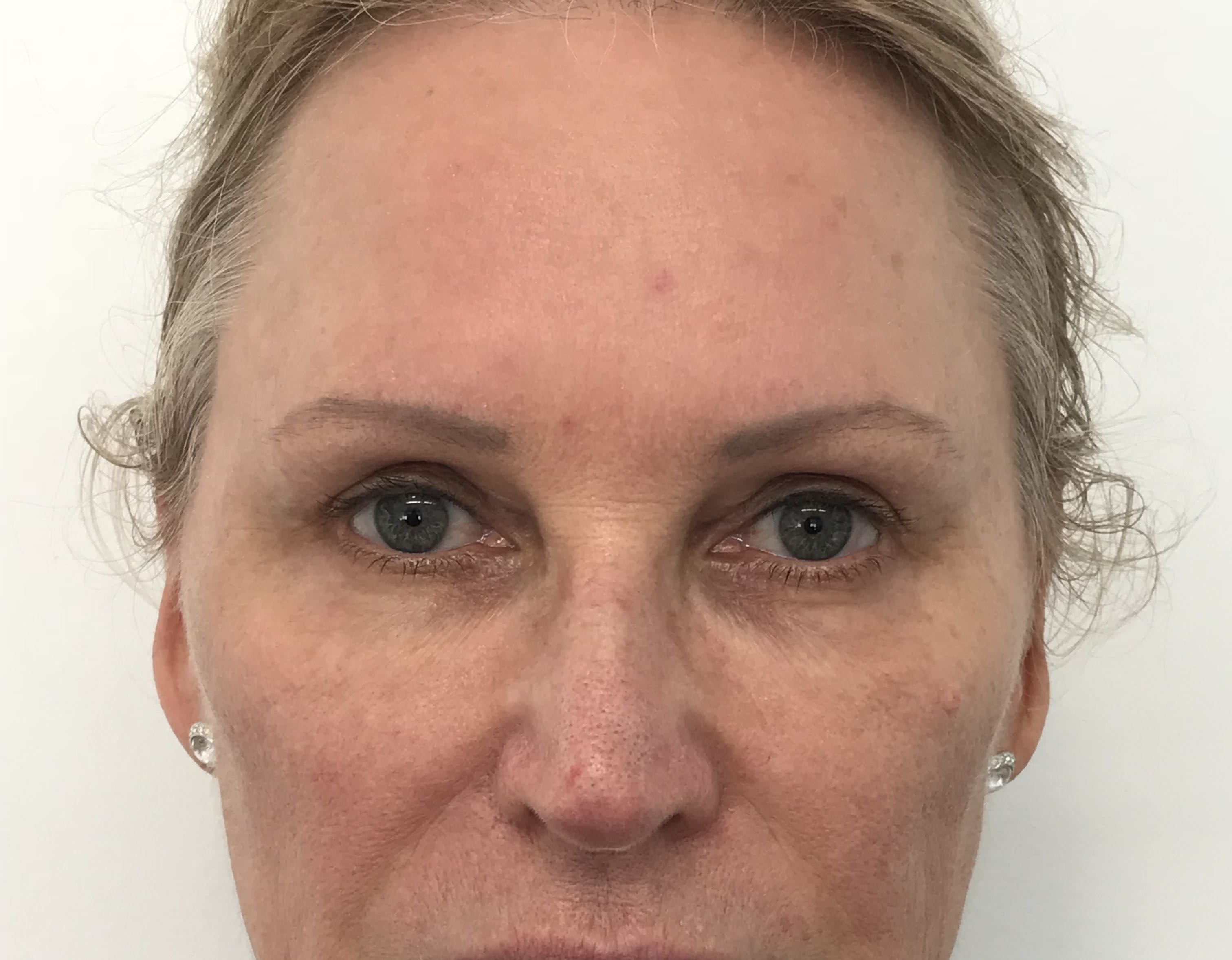 Blepharoplasty (Eyelid Surgery) clinical image 28