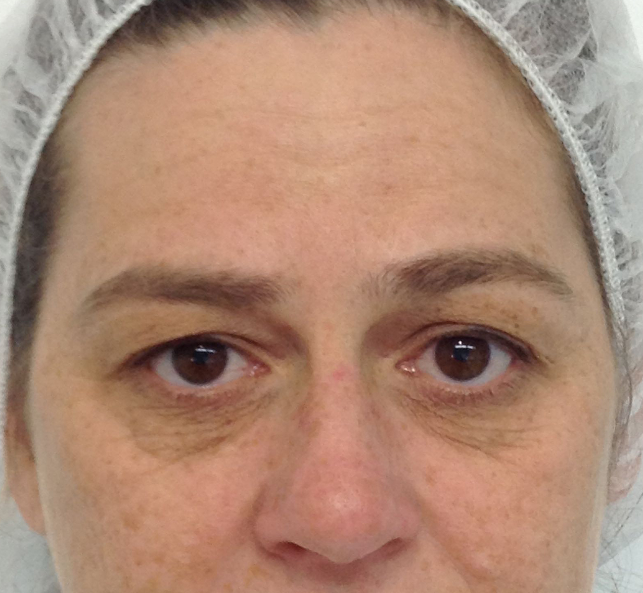 Blepharoplasty (Eyelid Surgery) clinical image 29