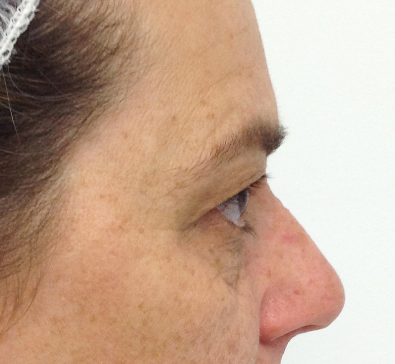Blepharoplasty (Eyelid Surgery) clinical image 30