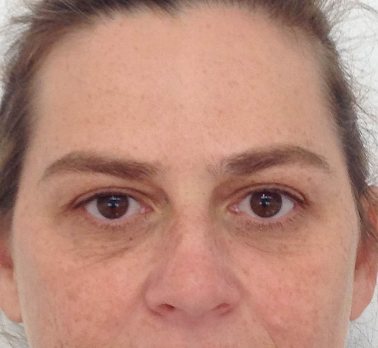 Blepharoplasty (Eyelid Surgery) clinical image 31