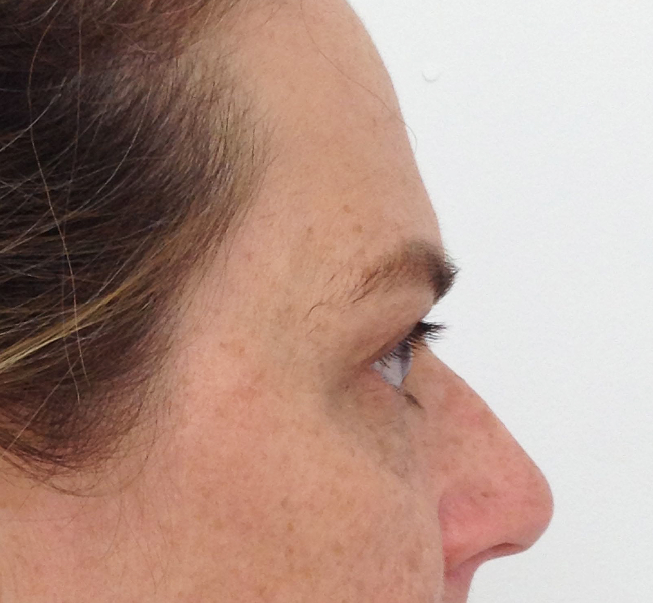 Blepharoplasty (Eyelid Surgery) clinical image 32