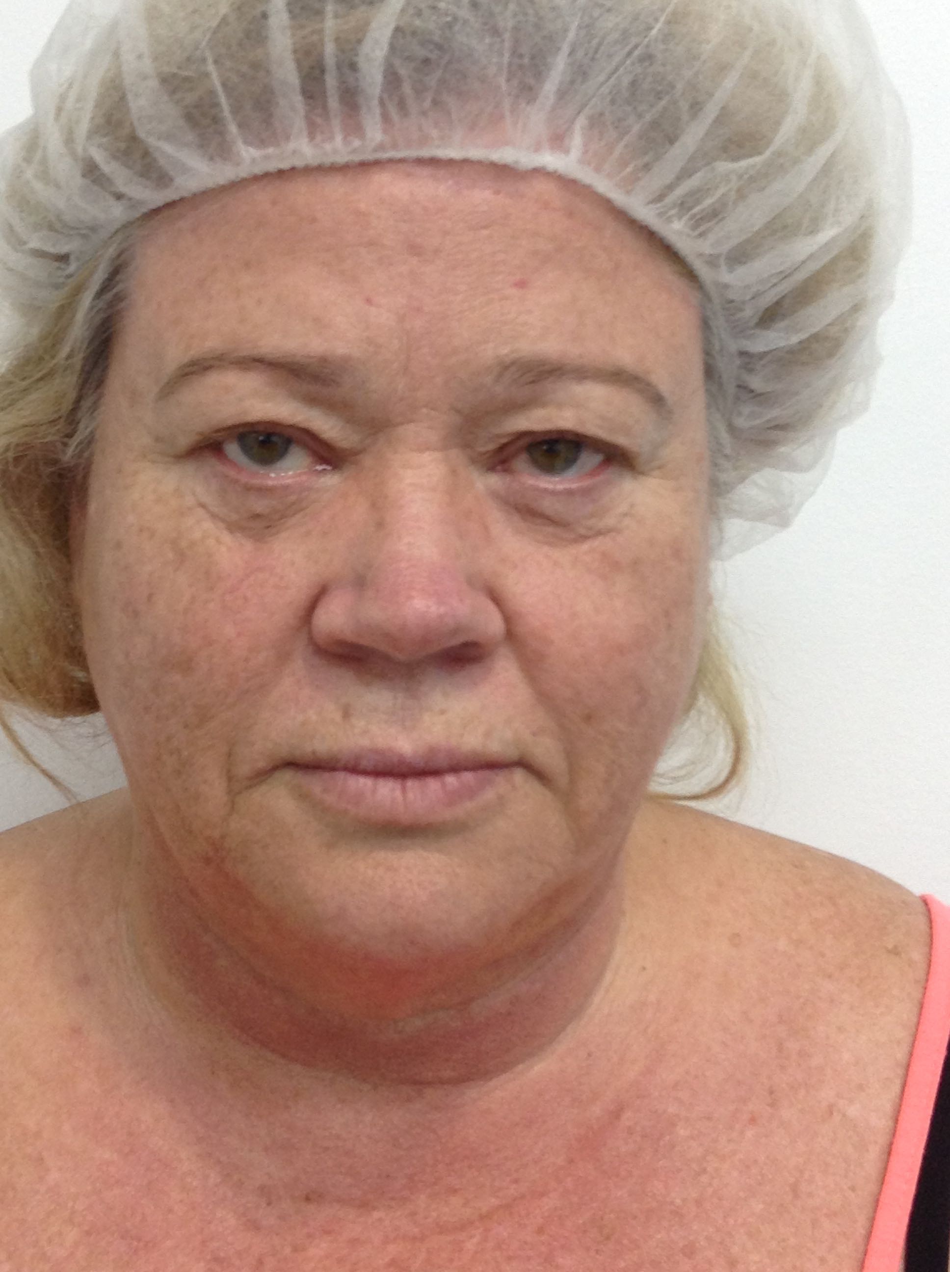 Blepharoplasty (Eyelid Surgery) clinical image 33