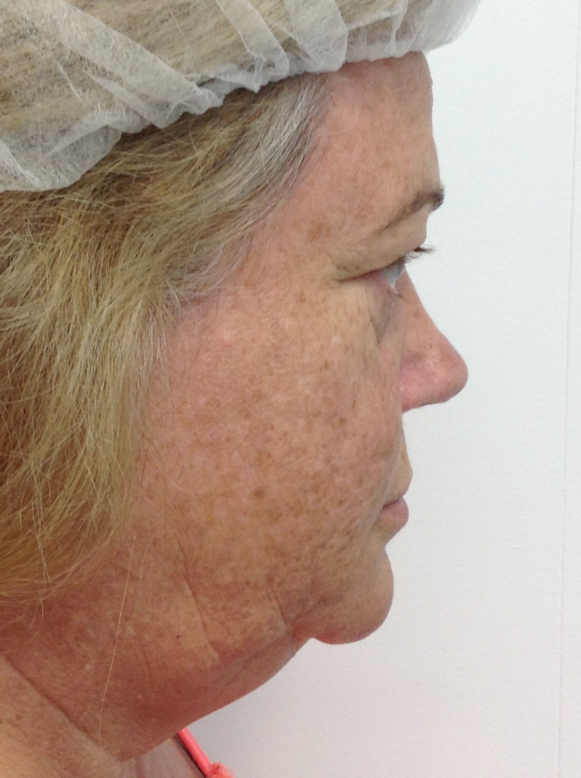 Blepharoplasty (Eyelid Surgery) clinical image 34