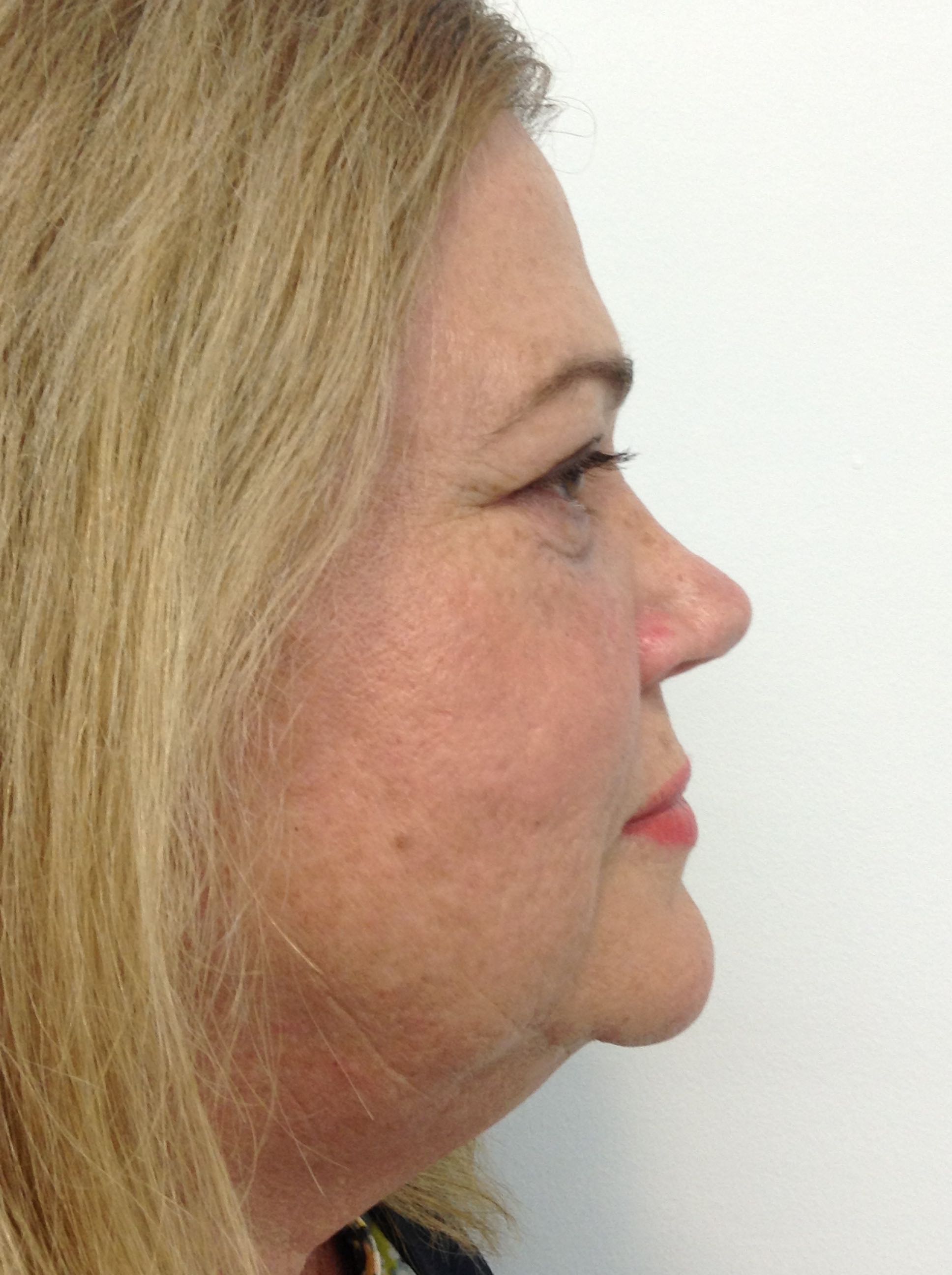 Blepharoplasty (Eyelid Surgery) clinical image 35