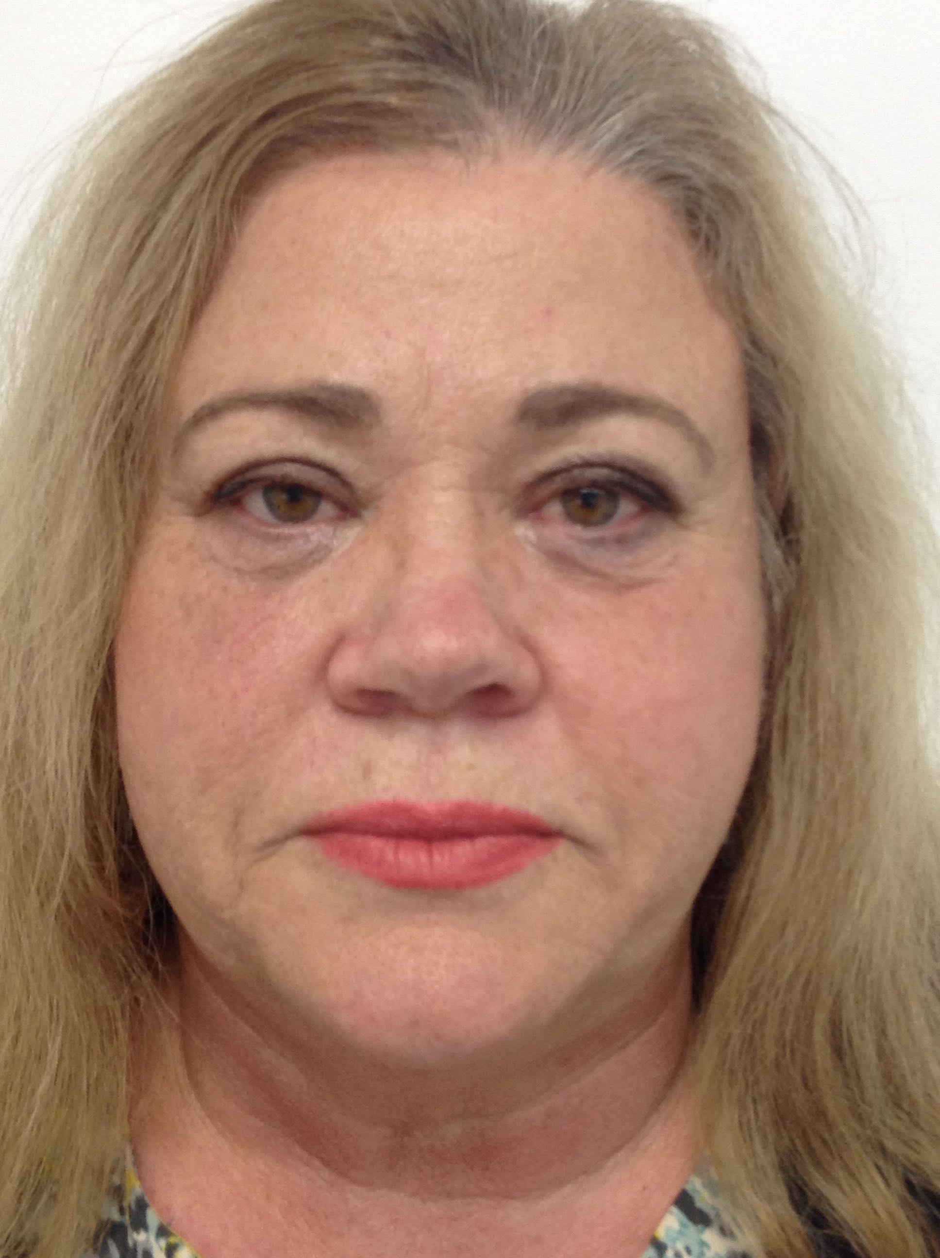 Blepharoplasty (Eyelid Surgery) clinical image 36