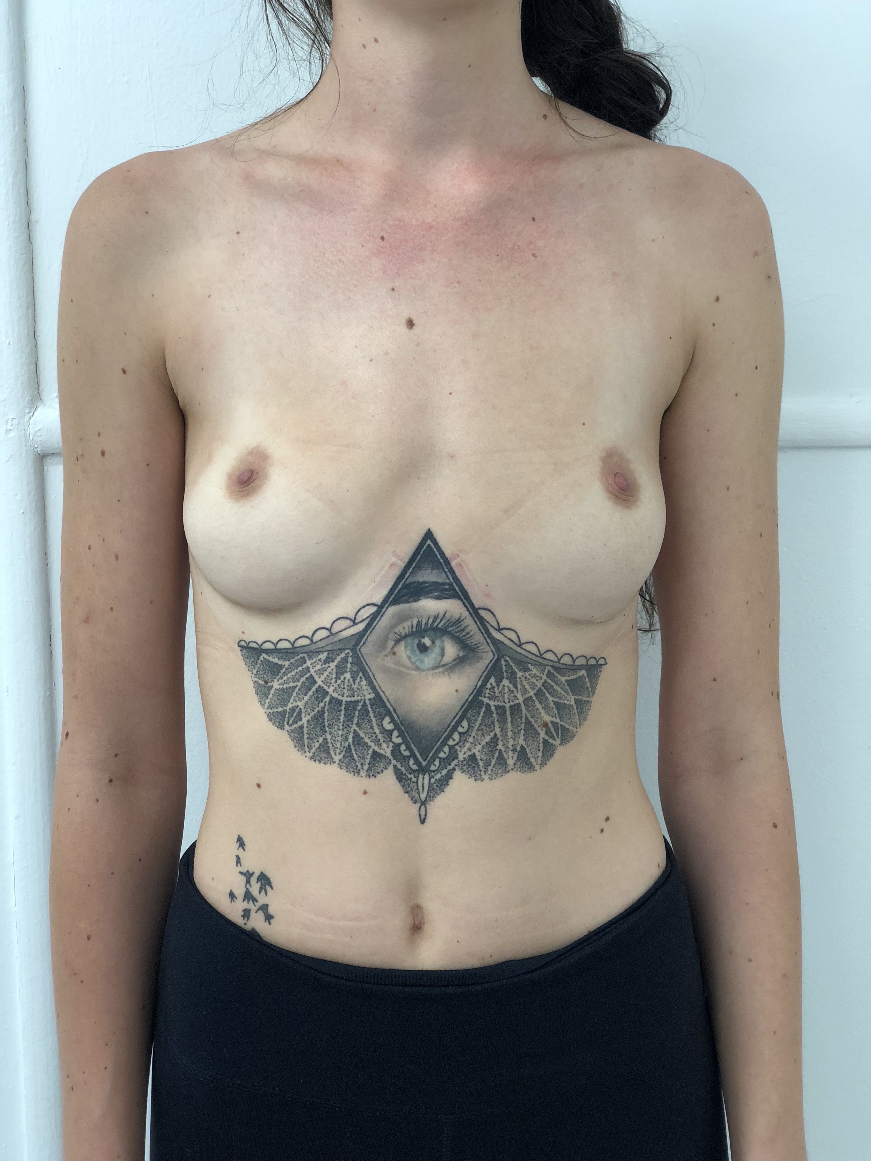 Breast Implant Explantation (Breast Implant Removal) clinical image 7