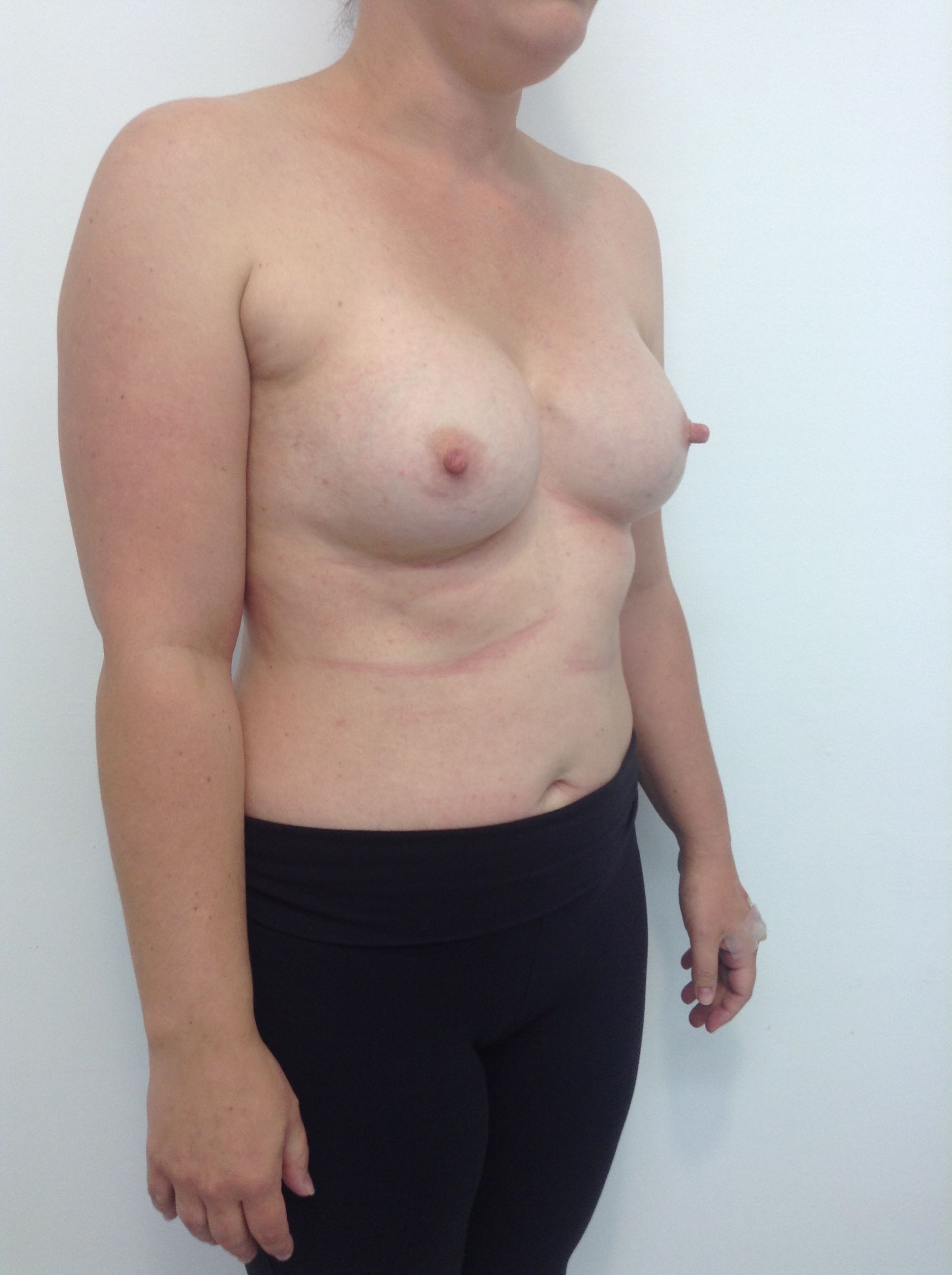 Breast Implant Explantation (Breast Implant Removal) clinical image 10