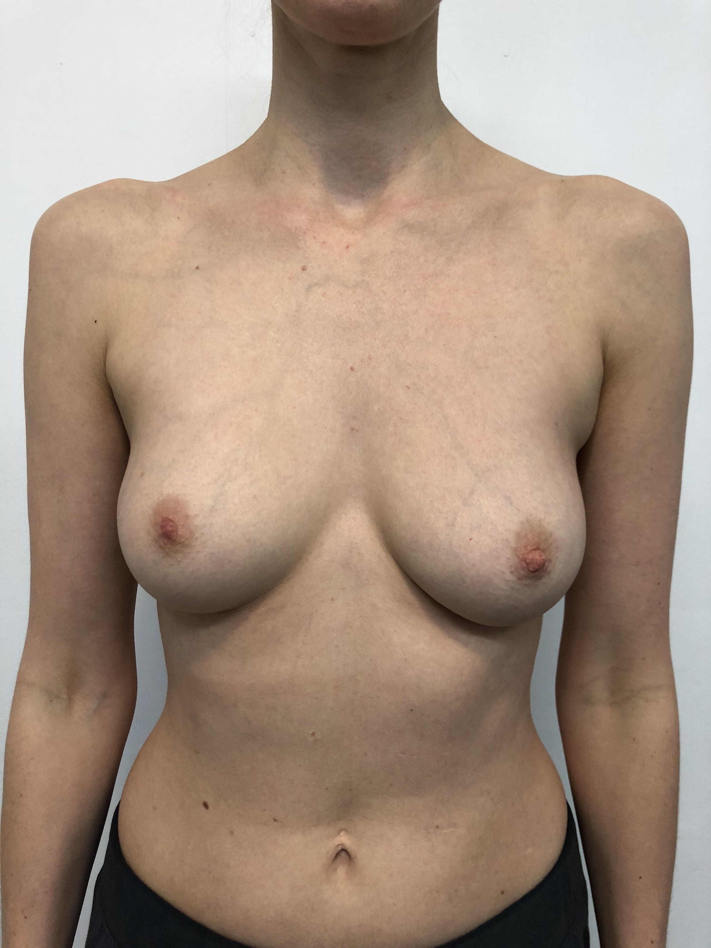 Breast Implant Explantation (Breast Implant Removal) clinical image 15