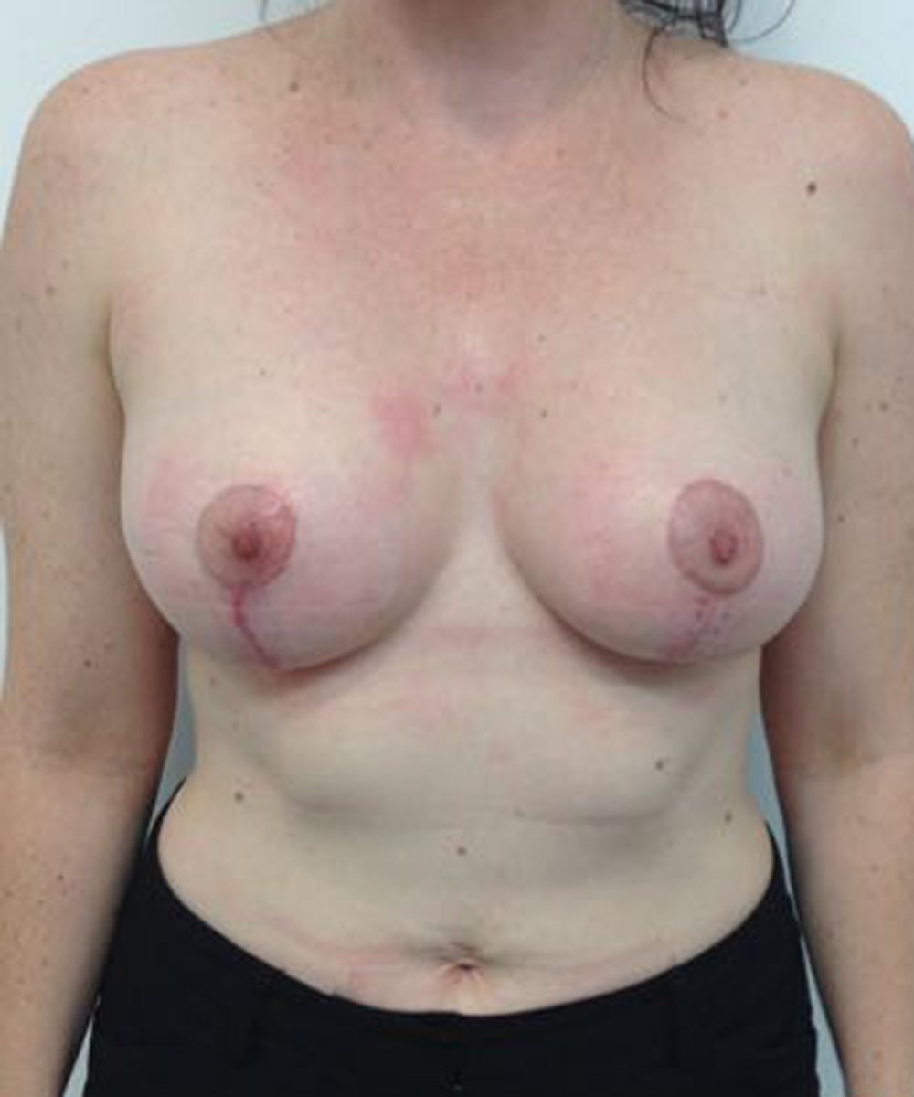 Mastopexy (Breast Lift) clinical image 23