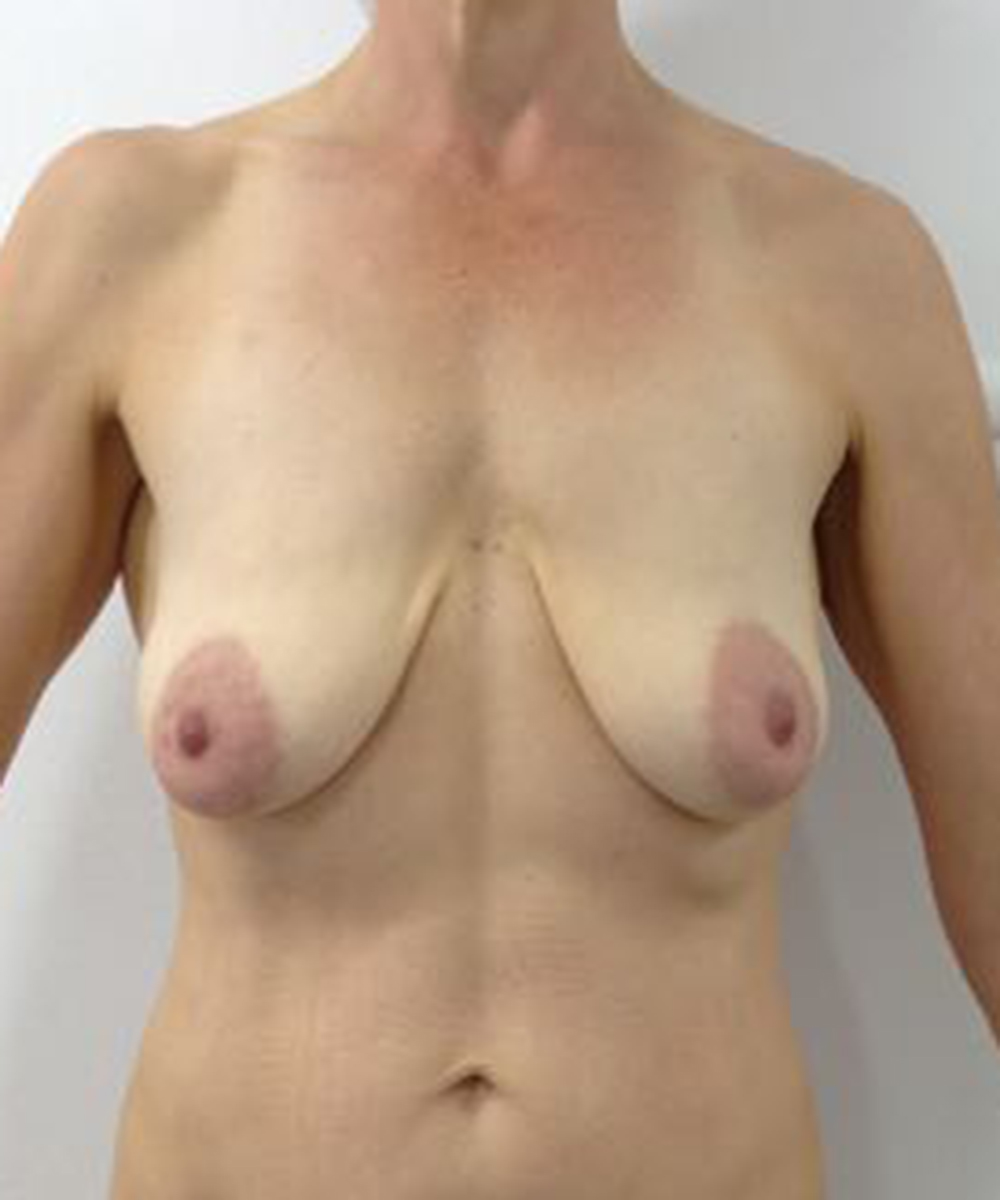 Mastopexy (Breast Lift) clinical image 25