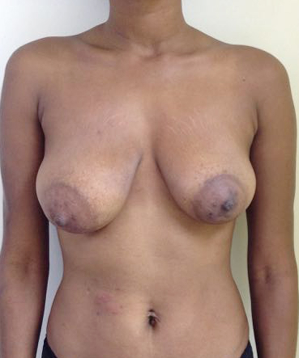Mastopexy (Breast Lift) clinical image 29