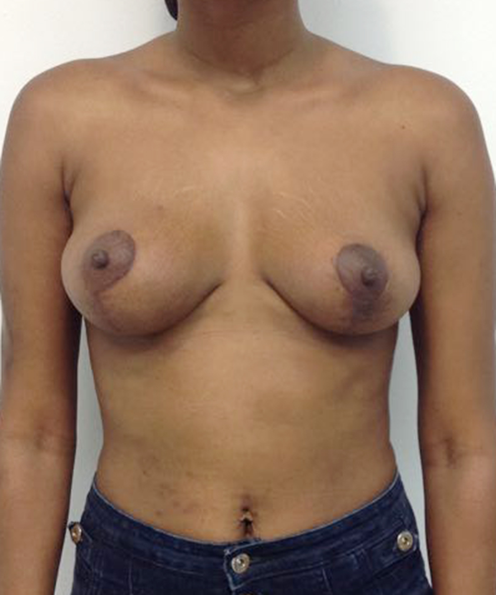 Mastopexy (Breast Lift) clinical image 31