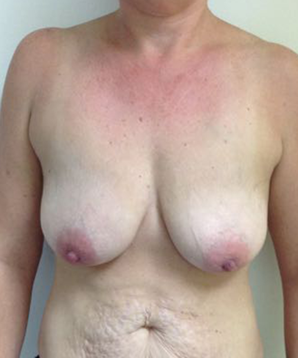 Mastopexy (Breast Lift) clinical image 33