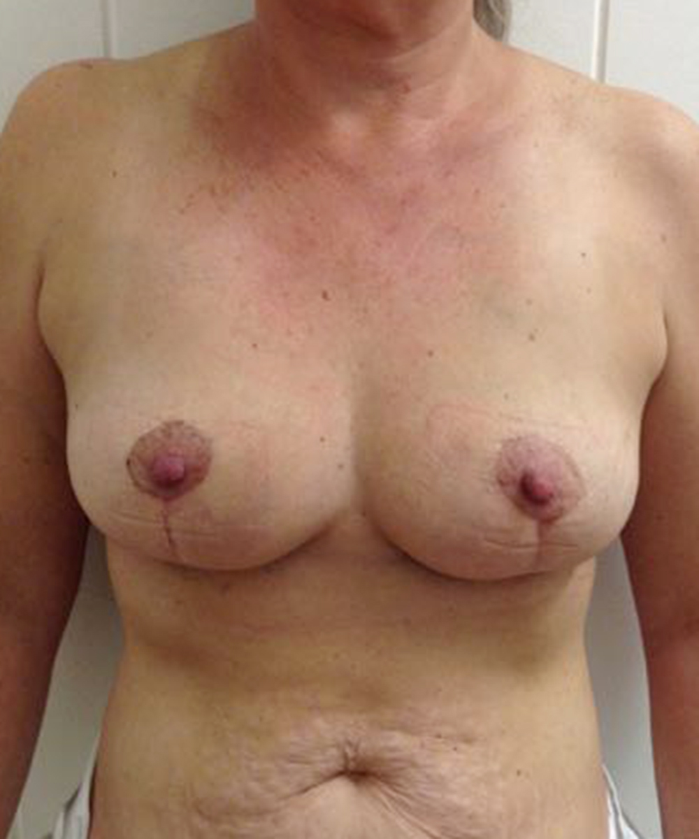 Mastopexy (Breast Lift) clinical image 35