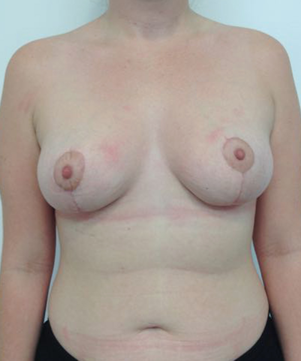 Mastopexy (Breast Lift) clinical image 39