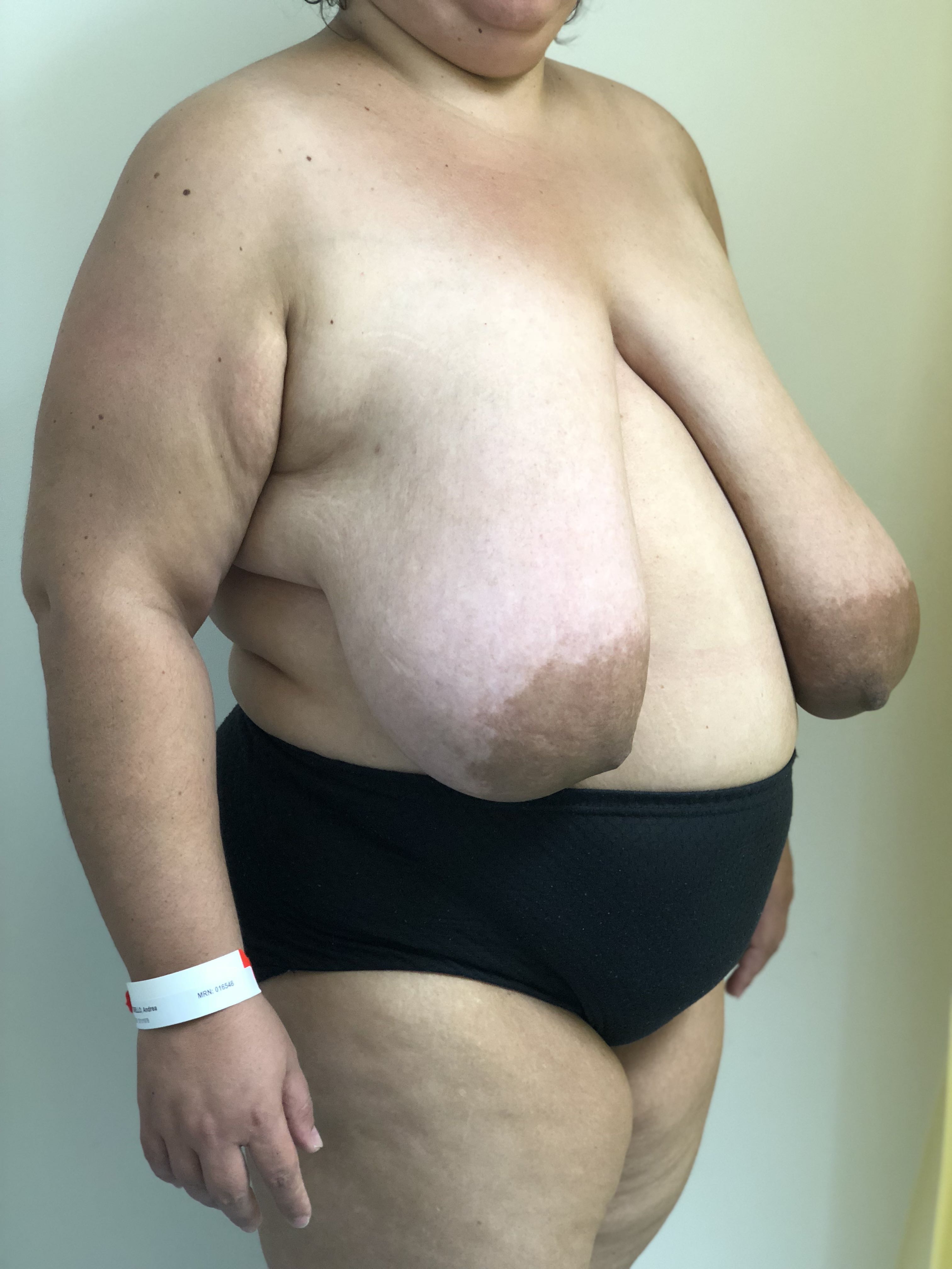 Reduction Mammaplasty (Breast Reduction) clinical image 14
