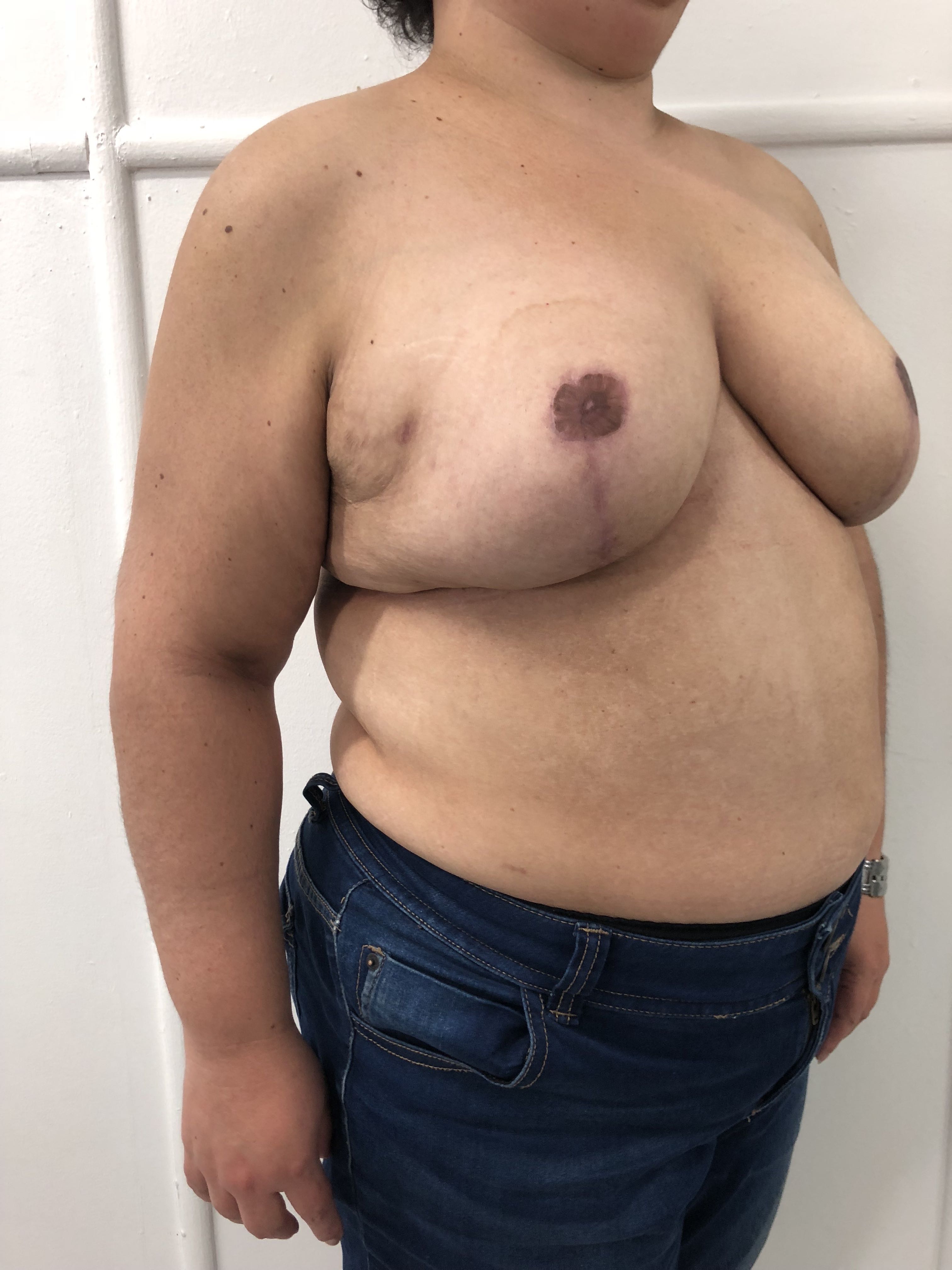 Reduction Mammaplasty (Breast Reduction) clinical image 16