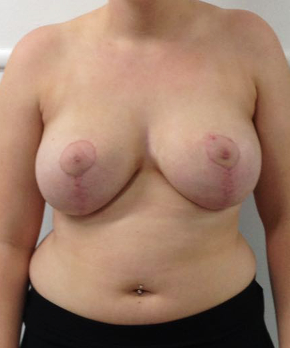Reduction Mammaplasty (Breast Reduction) clinical image 23