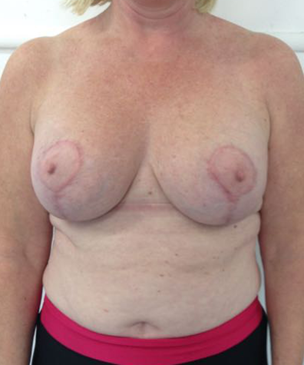 Reduction Mammaplasty (Breast Reduction) clinical image 27