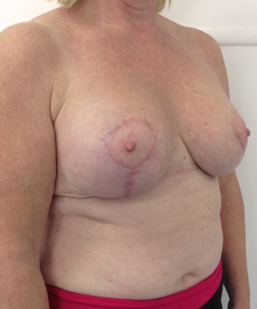 Reduction Mammaplasty (Breast Reduction) clinical image 28