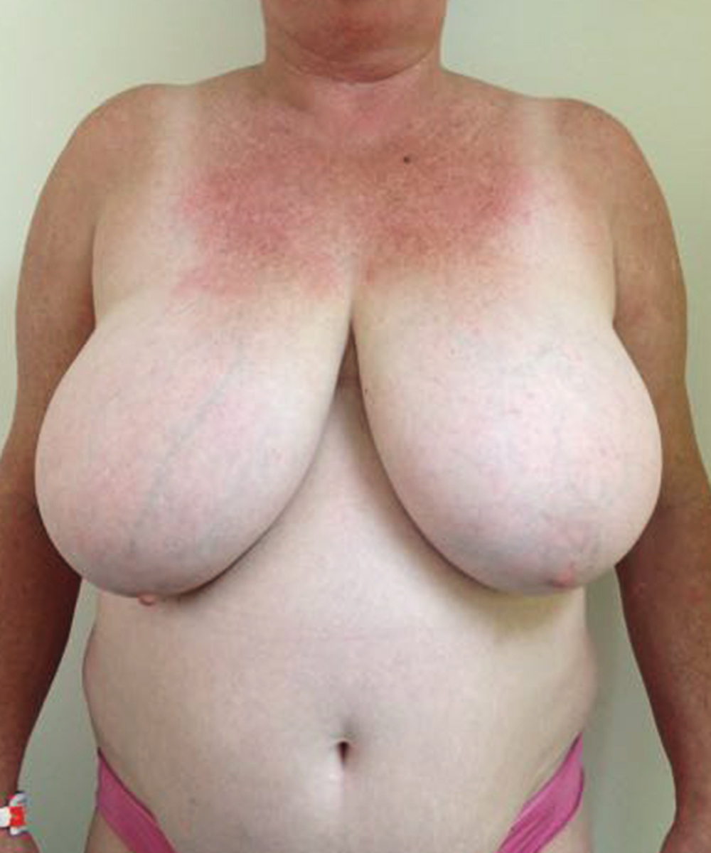 Reduction Mammaplasty (Breast Reduction) clinical image 33
