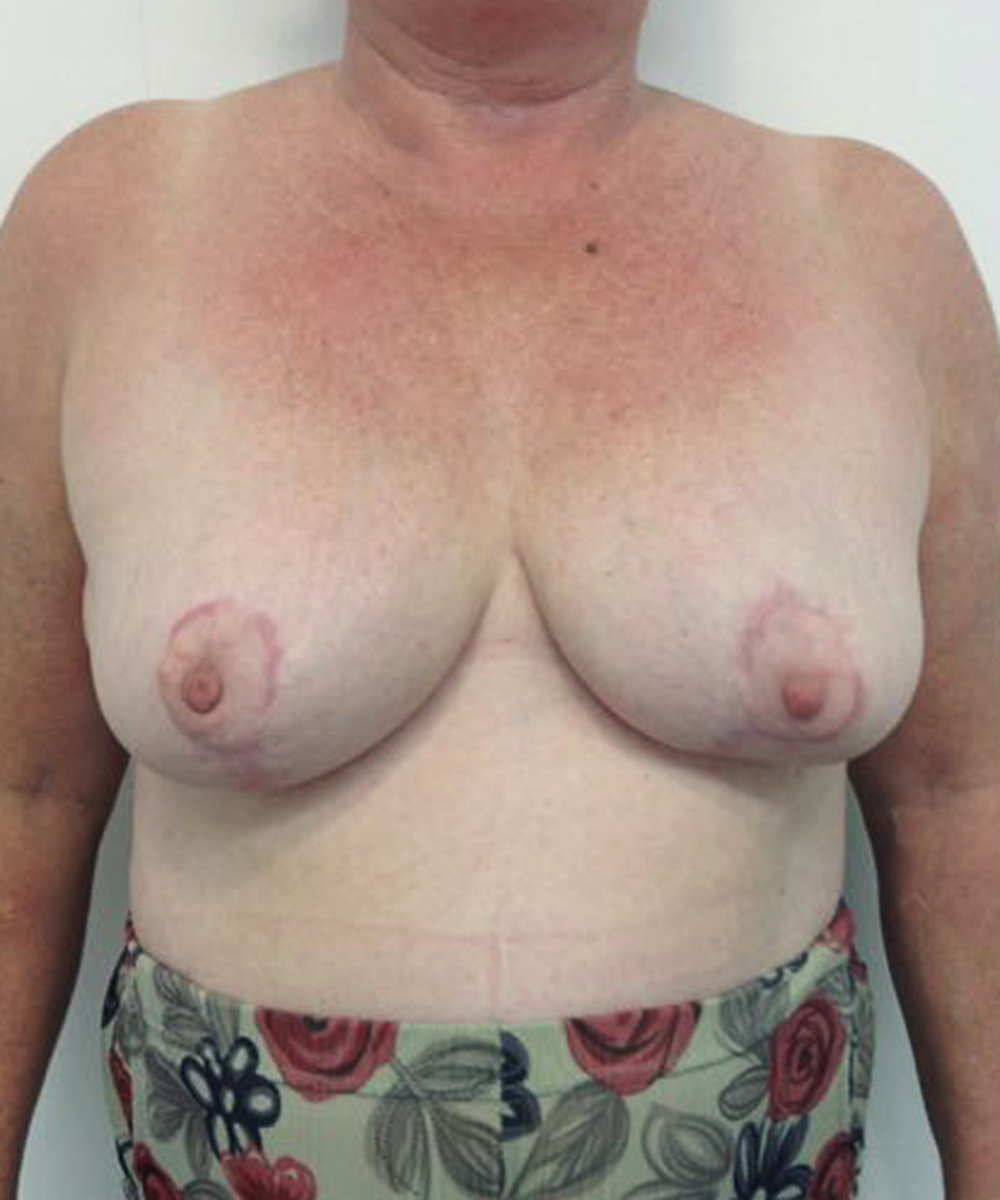 Reduction Mammaplasty (Breast Reduction) clinical image 35