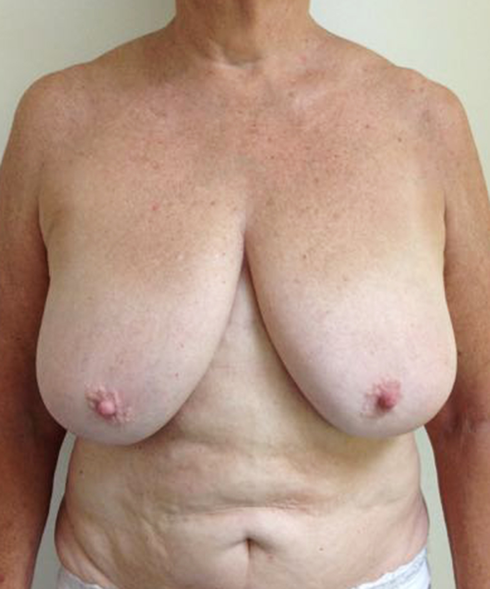 Reduction Mammaplasty (Breast Reduction) clinical image 37