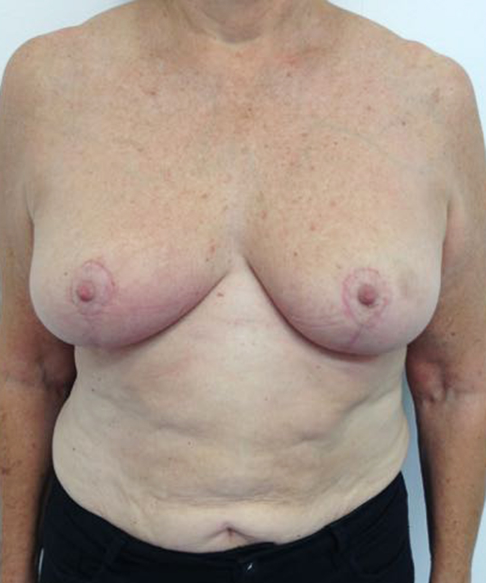 Reduction Mammaplasty (Breast Reduction) clinical image 39