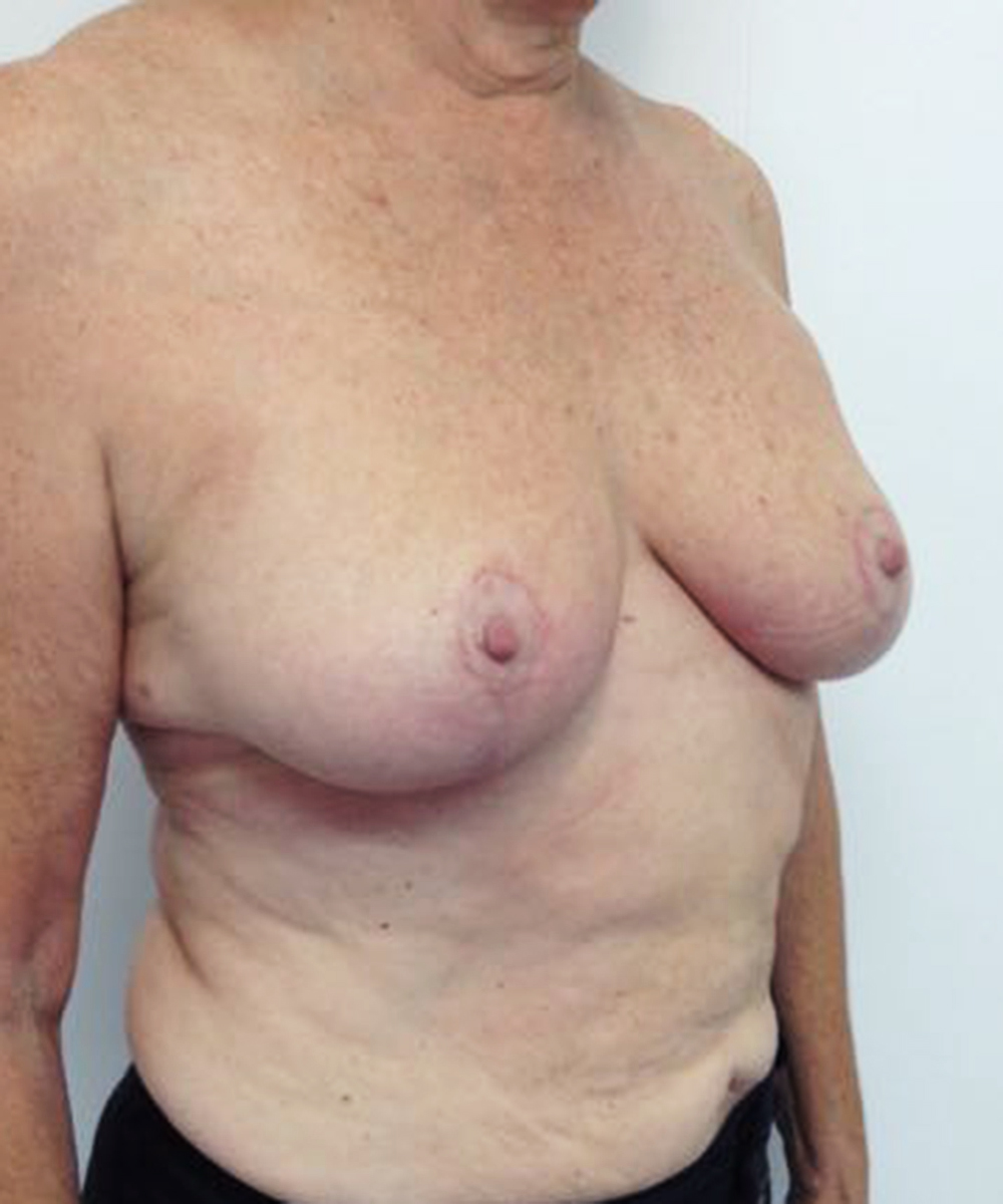 Reduction Mammaplasty (Breast Reduction) clinical image 40