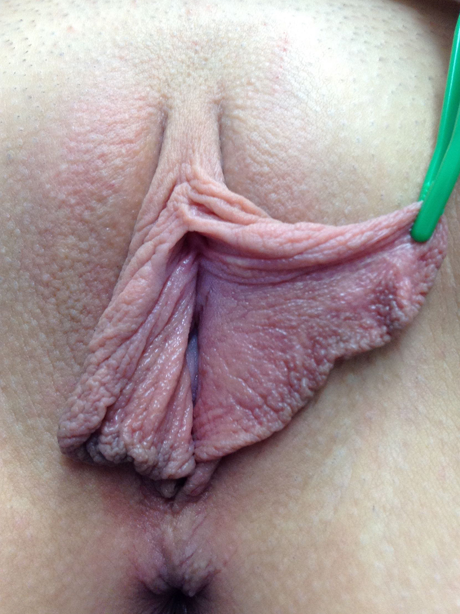 Labiaplasty (Labia Reduction) clinical image 20