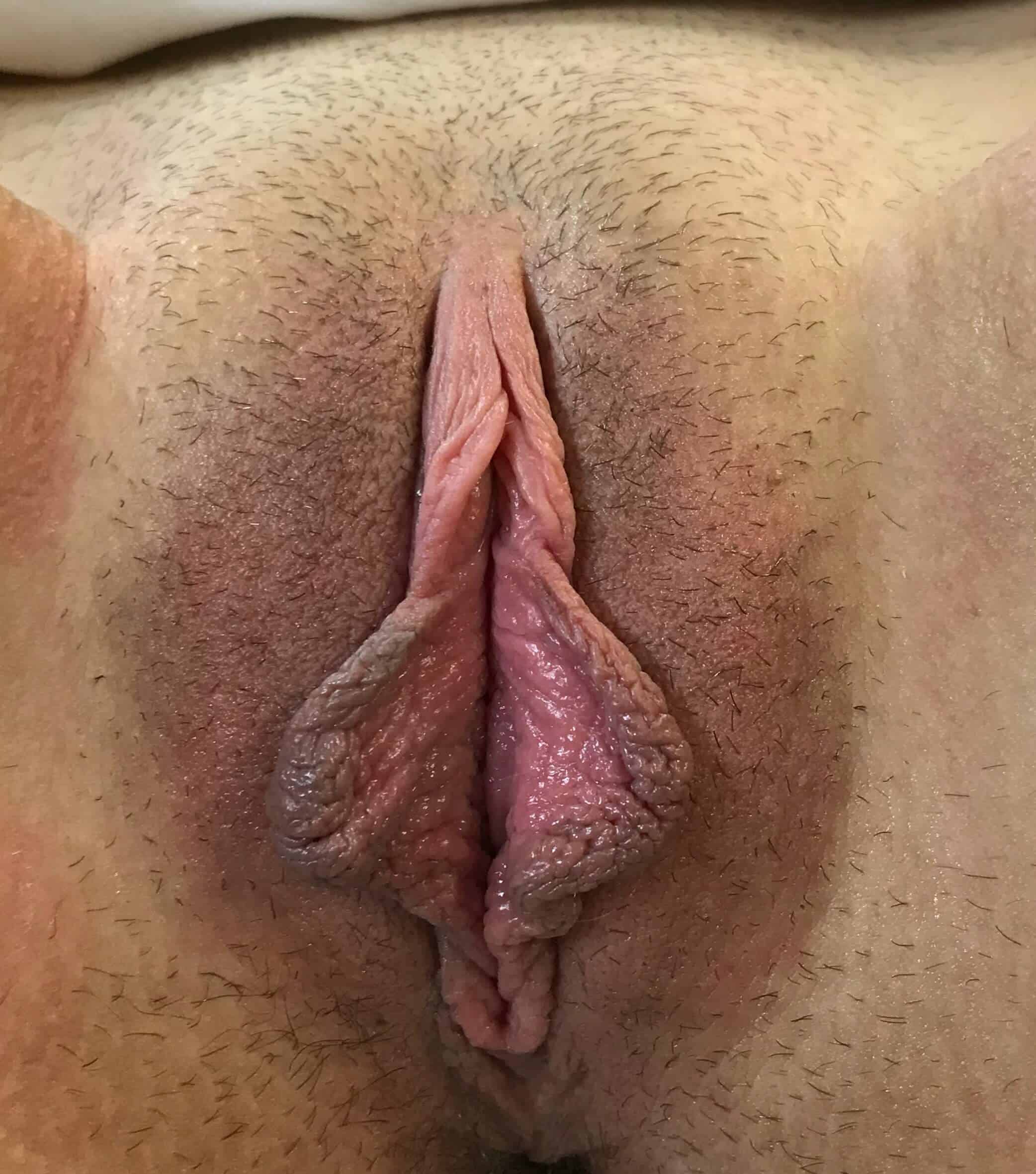 Labiaplasty (Labia Reduction) clinical image 40