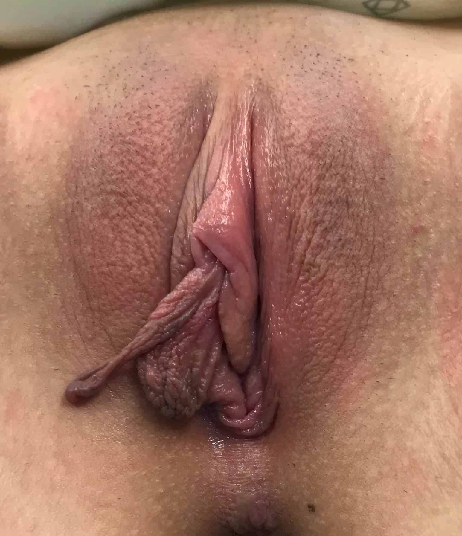 Labiaplasty (Labia Reduction) clinical image 42