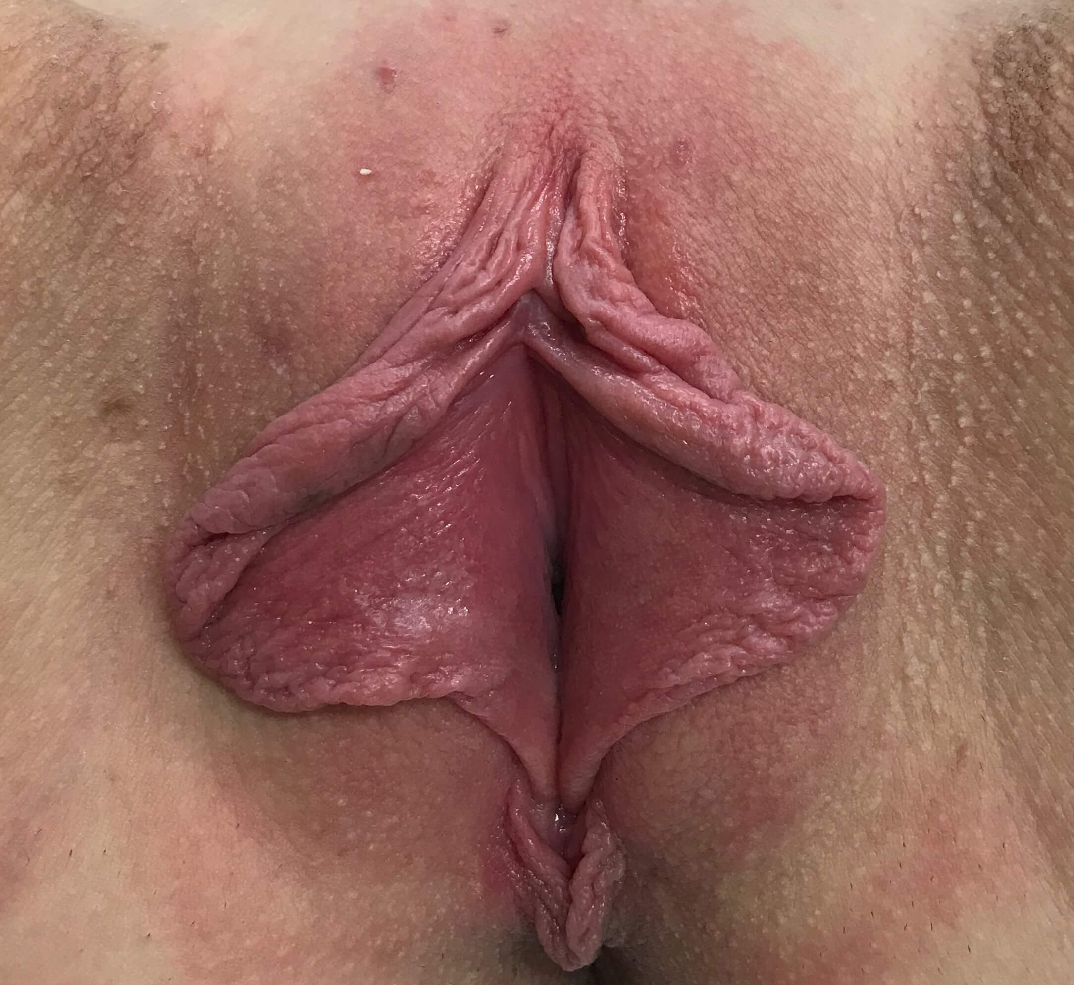 Labiaplasty (Labia Reduction) clinical image 50
