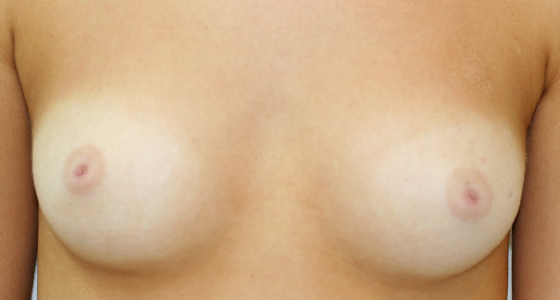 Inverted Nipple Correction (Inverted Nipple Surgery) clinical image 1