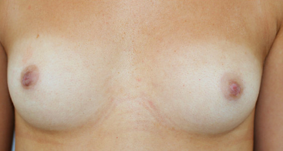 Inverted Nipple Correction (Inverted Nipple Surgery) clinical image 2