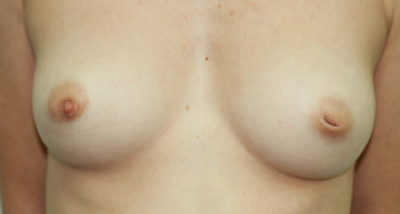 Inverted Nipple Correction (Inverted Nipple Surgery) clinical image 3