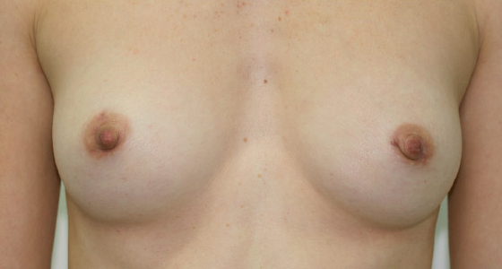 Inverted Nipple Correction (Inverted Nipple Surgery) clinical image 4