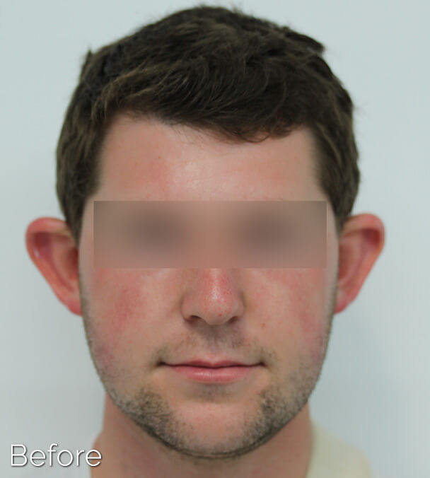 Otoplasty (Ear Pinning) clinical image 1