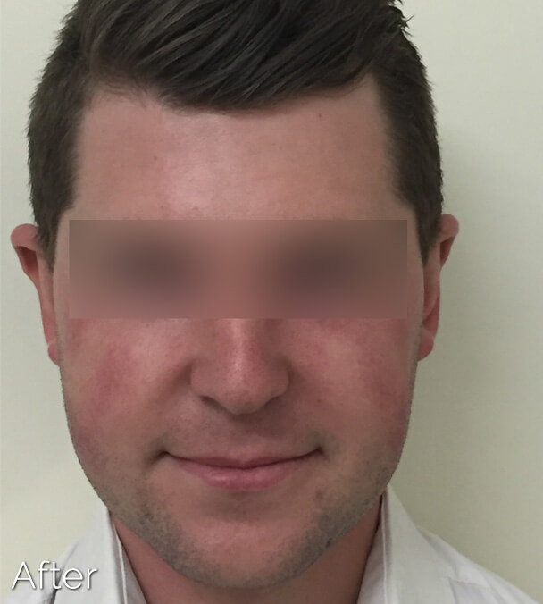 Otoplasty (Ear Pinning) clinical image 2