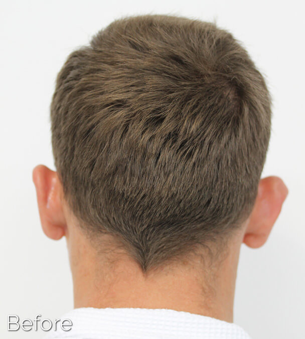 Otoplasty (Ear Pinning) clinical image 3