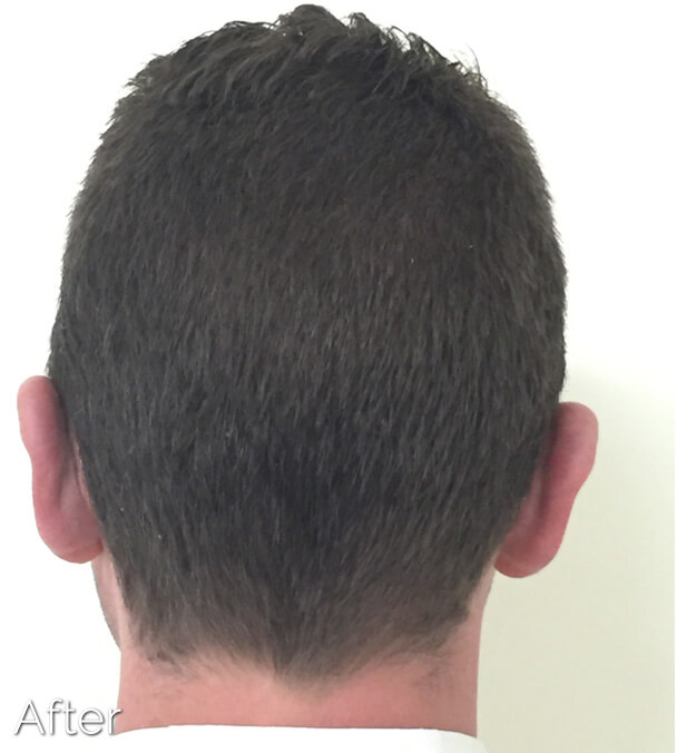 Otoplasty (Ear Pinning) clinical image 4