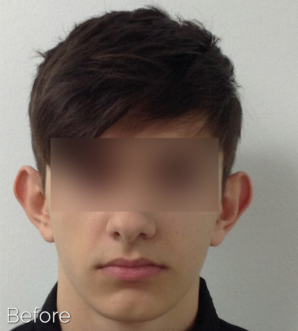 Otoplasty (Ear Pinning) clinical image 5