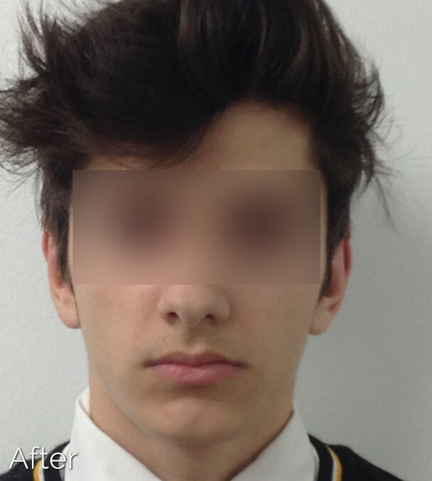 Otoplasty (Ear Pinning) clinical image 6