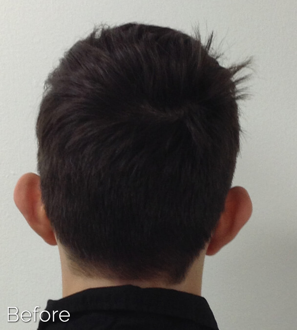 Otoplasty (Ear Pinning) clinical image 7