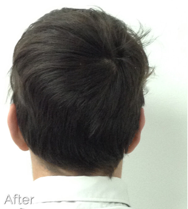 Otoplasty (Ear Pinning) clinical image 8