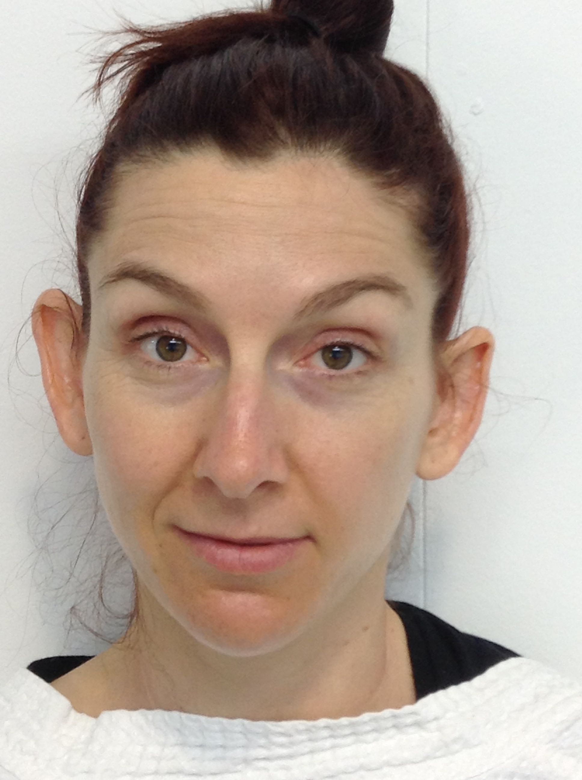 Otoplasty (Ear Pinning) clinical image 9