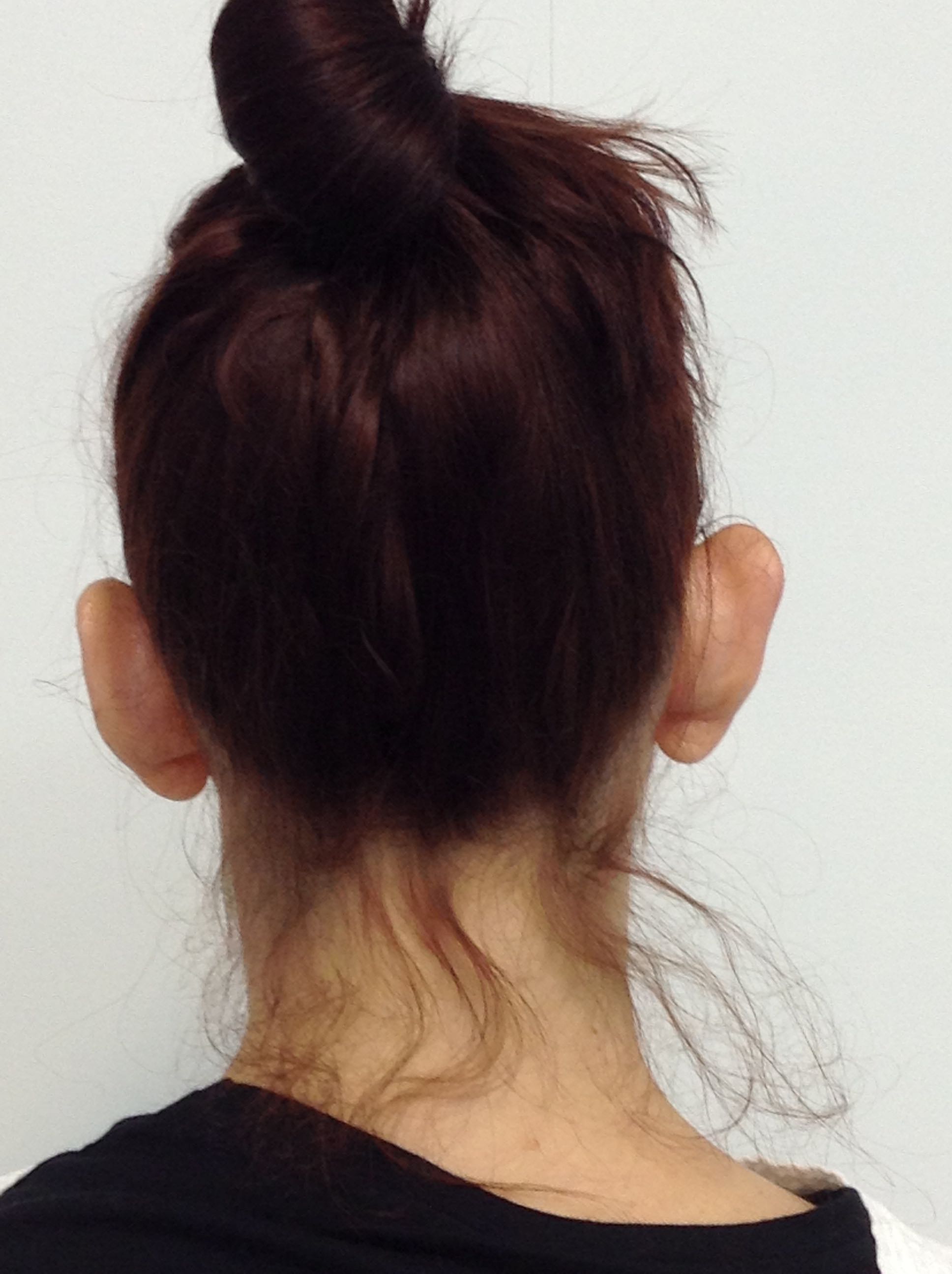 Otoplasty (Ear Pinning) clinical image 10