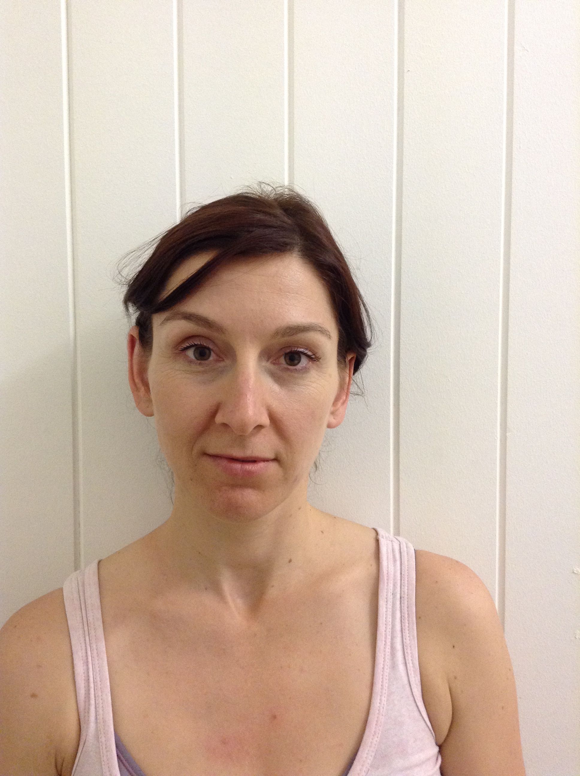 Otoplasty (Ear Pinning) clinical image 11