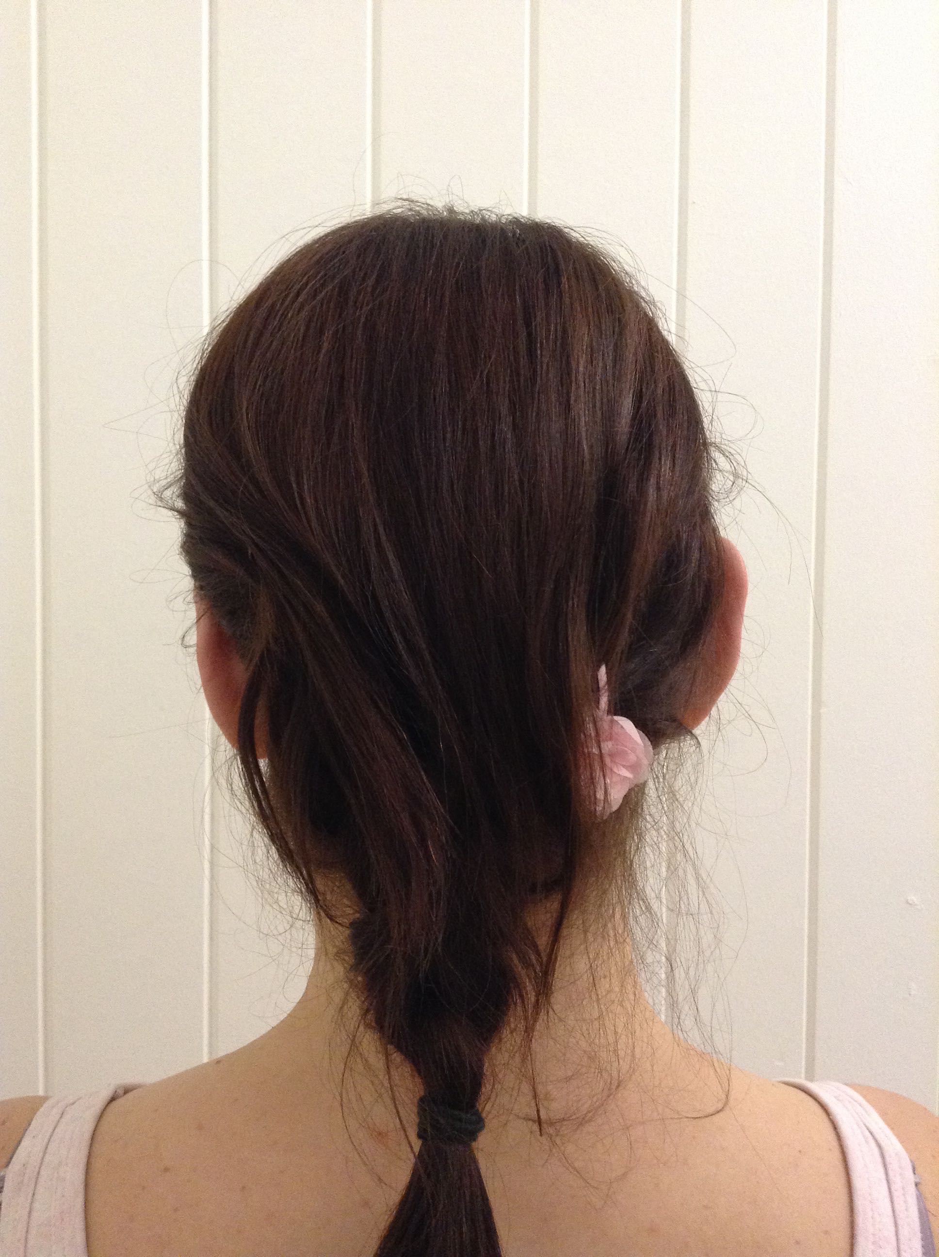 Otoplasty (Ear Pinning) clinical image 12