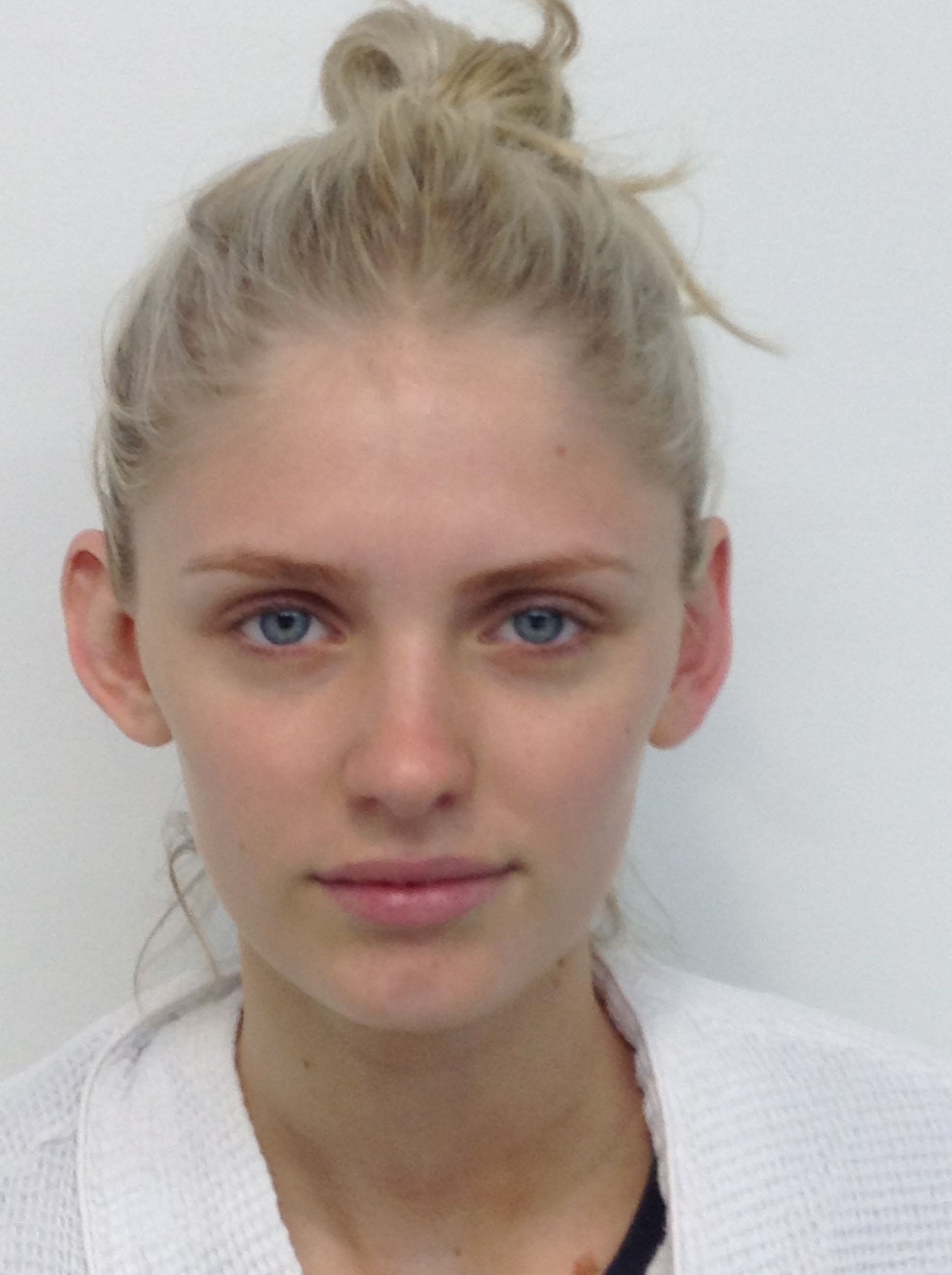 Otoplasty (Ear Pinning) clinical image 13